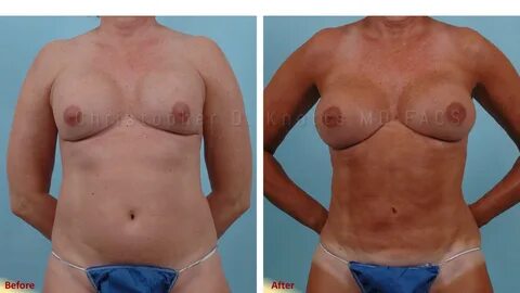 Note: his patient had older breast implants that were sitting very high and...
