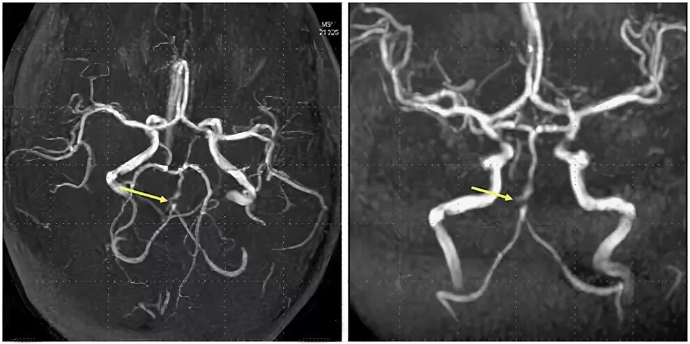 Гипоплазия позвоночной артерии кт. Гипоплазия позвоночной артерии мрт. Гипоплазия а1 правой передней мозговой артерии. Гипоплазия сегмента а1 правой ПМА.