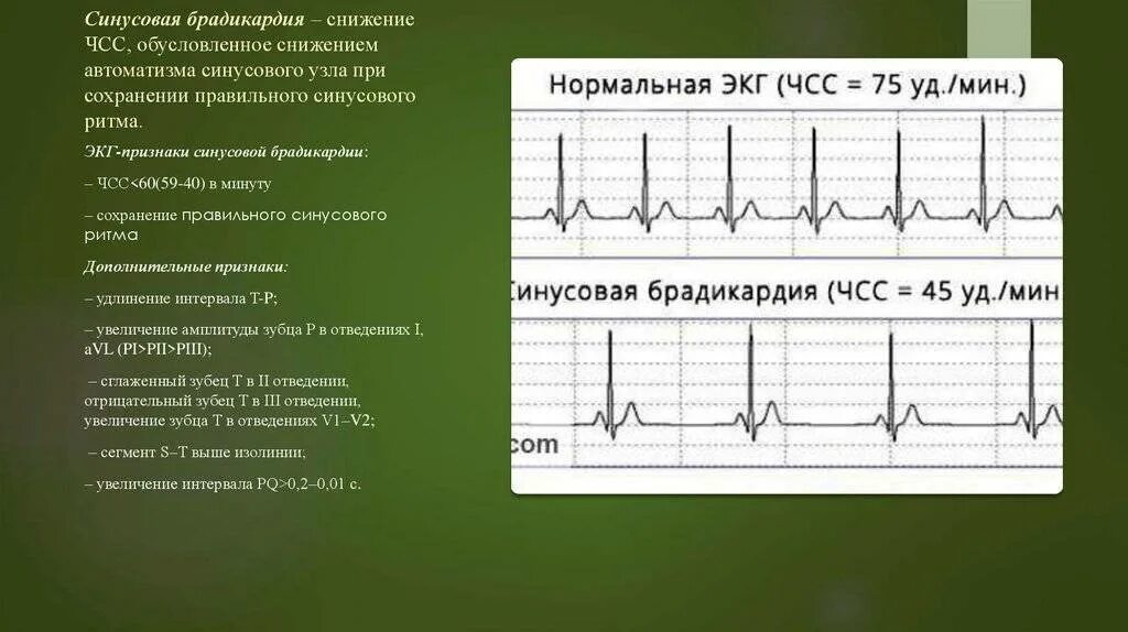 Тахикардия у ребенка 10 лет