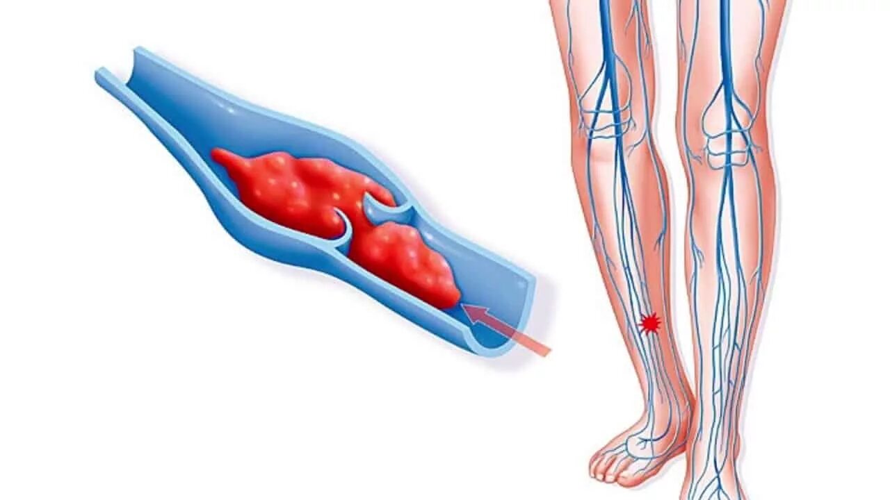 коронарное стентирование сосудов сердца. сосуды кровеносной системы. баллонная ангиопластика и стентирование. стентирование тромбоз. острый тромбоз артерий.