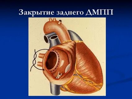 Закрытие дмпп