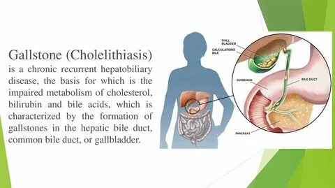Cholelithiasis латынь