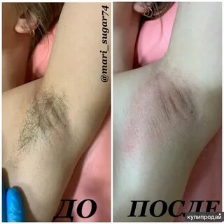 Эффективное удаление волос