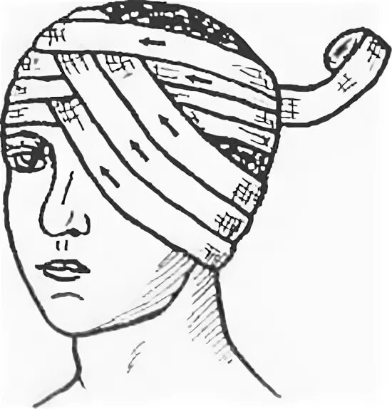 Повязка гиппократа техника наложения. Чепец и шапочка Гиппократа. Гиппократ повязка. Повязка чепец и шапочка Гиппократа. Повязка Гиппократа алгоритм.