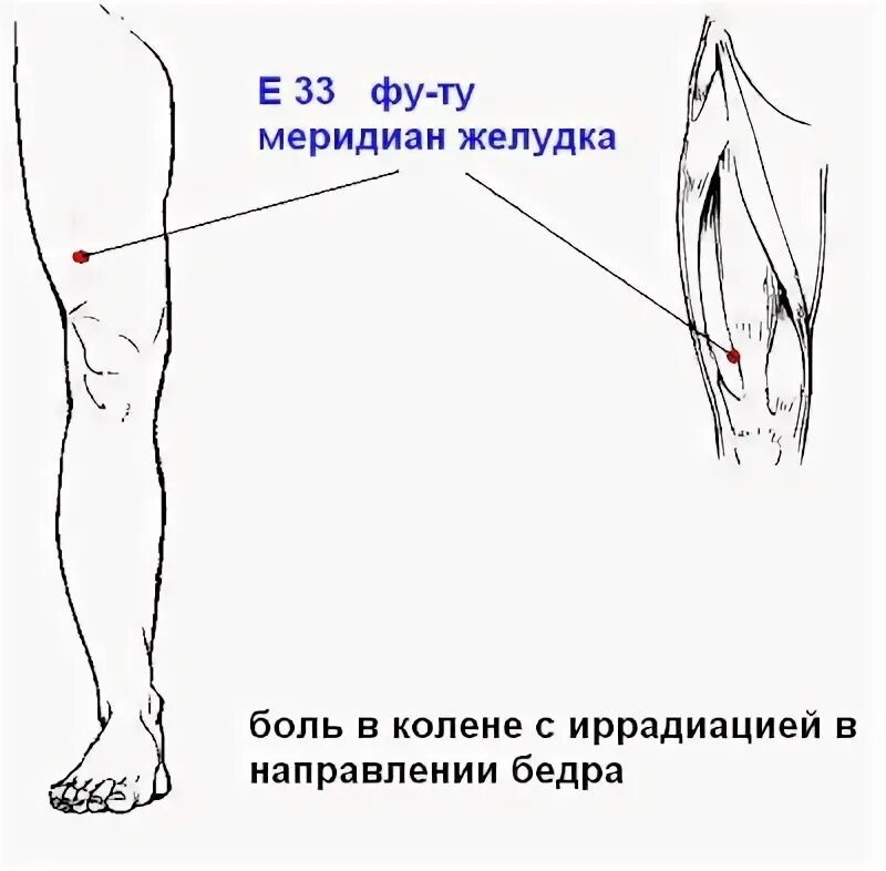 Иррадиация боли в бедре