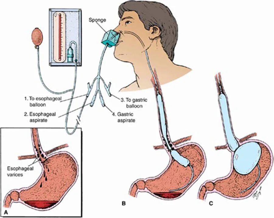 Установленный зонд Сенгстакена-Блэкмора. Зонд Блэкмора при кровотечении. Баллонная тампонада зонд Блэкмора. Зонд сенгстейки- на-блейкмо- ра. Абляция пищевода