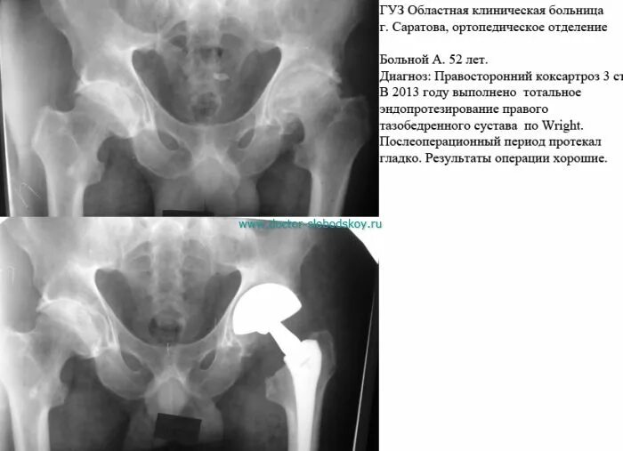 Мрт после эндопротезирования. Коксартроз тазобедренного сустава мрт. Коксартроз тазобедренного диагноз. Коксартроз 2 степени рентген.