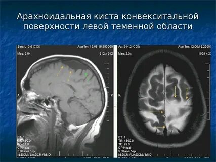 Арахноидальная киста отзывы
