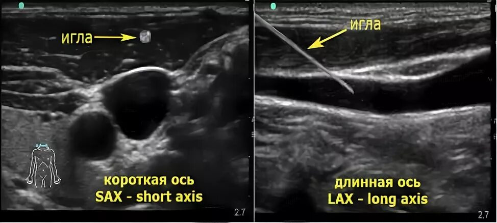 Короткая ось лимфоузла. Катетеризация центральных вен под контролем УЗИ. Катетеризация подключичной вены УЗИ. Катетеризация подключичной вены под УЗИ контролем.