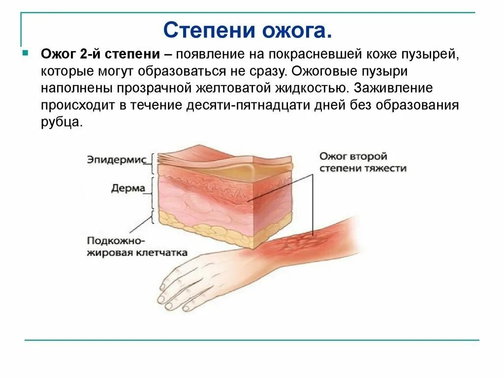 Ожог 2 степени степень тяжести. Ожог 1 степени и 2 степени. Ожоги 1 степень 2 степень 3 степень 4 степень. Ожоги 1-2 степени тяжести описание.