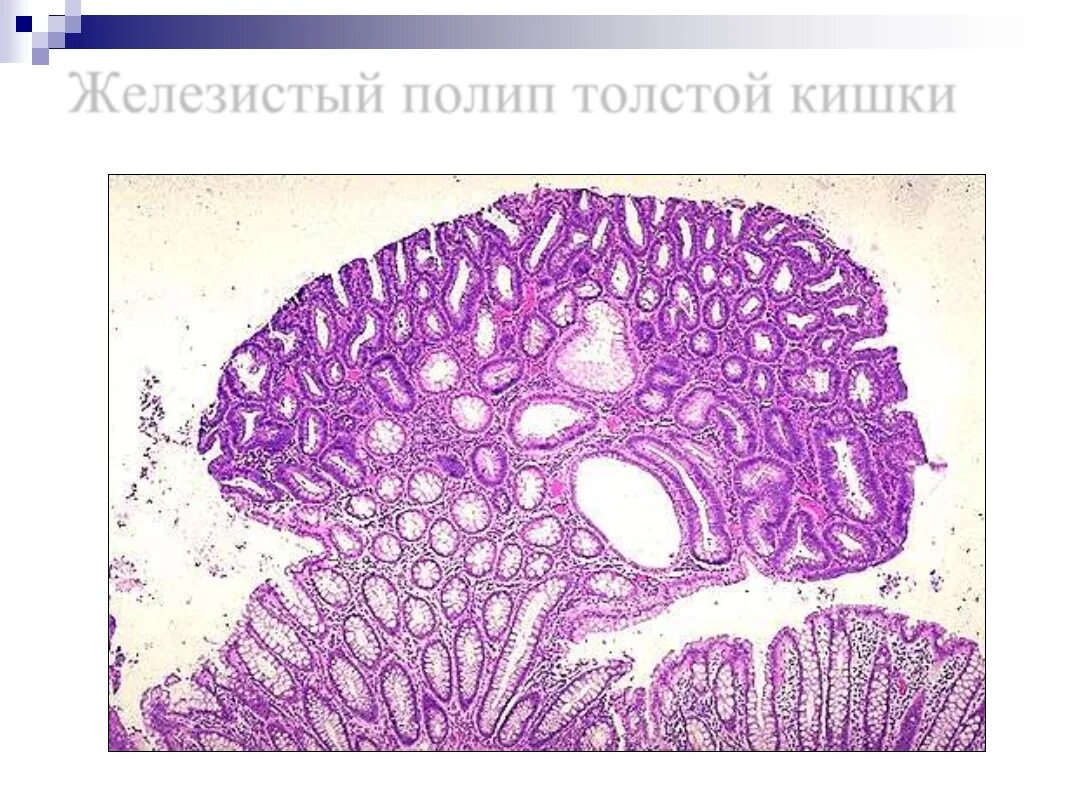 Микровезикулярный полип толстой кишки. Аденома толстой кишки гистология. Полип толстой кишки макропрепарат. Аденома кишечника гистология. Тубулярная аденома толстой кишки гистология.