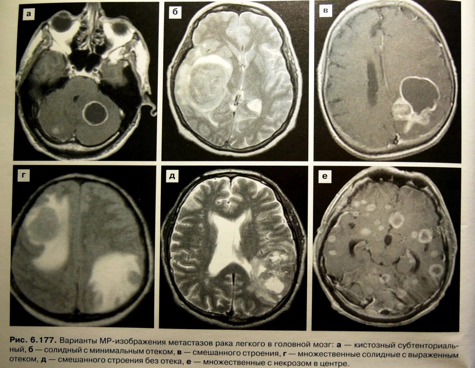Лечение метастазов мозга. Метастазы головного мозга кт кт. Кистозные метастазы головного мозга.