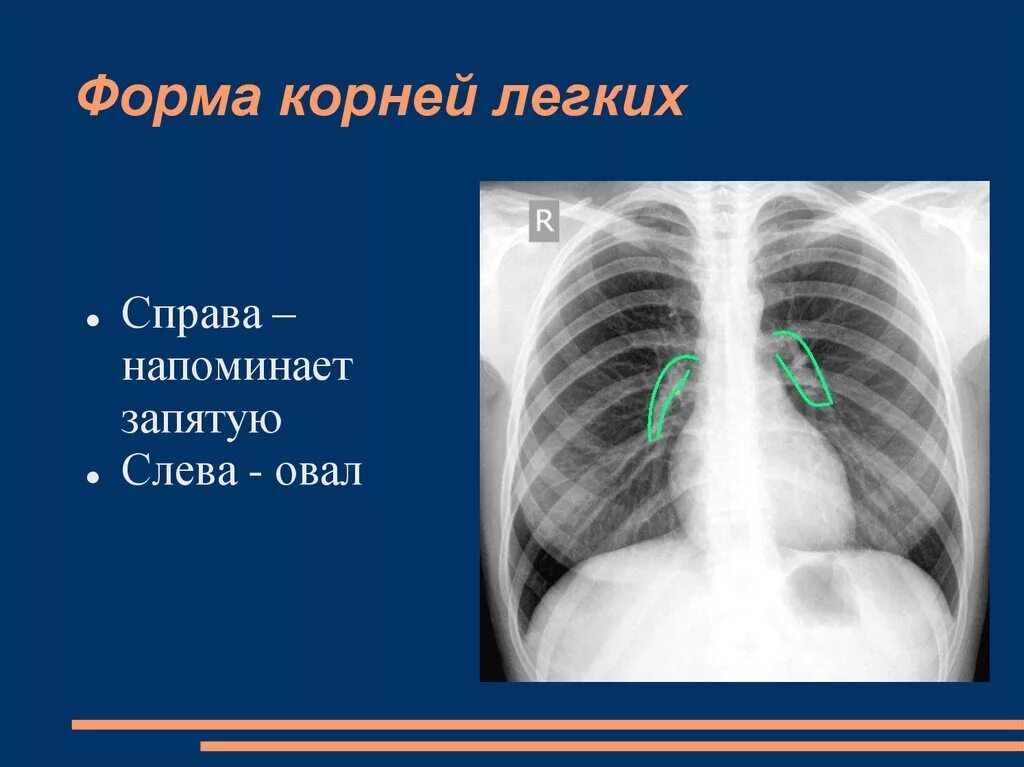 Корень легкого на рентгенограмме. Расширение корня легкого. Нормальный корень легкого на рентгене. Структура корня легкого.