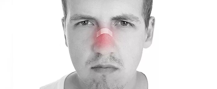 Повреждение мягких тканей носа.