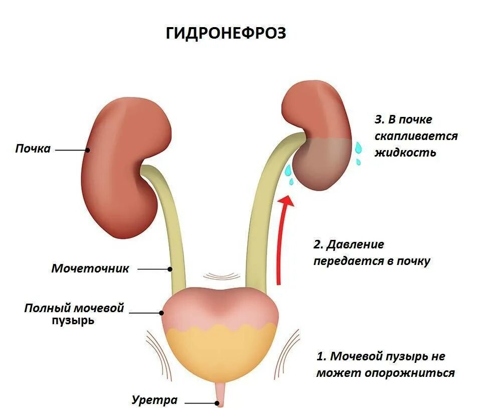 Врожденный гидронефроз патогенез. Клинические симптомы гидронефроза. Гидронефротическая трансформация почки причины.