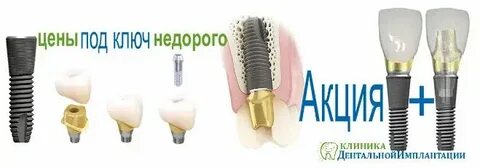 Имплантация под ключ в москве недорого