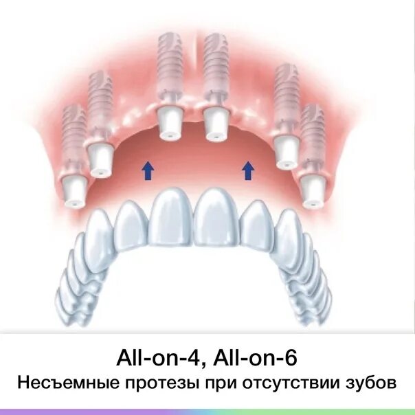 Имплантация зубов all on 6. All in 6имплантах трансинусально. Циркониевые протезы на 4 имплантах. Адаптационный протез на 6 имплантатах.