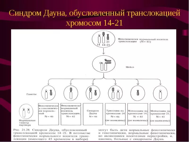 Робертсоновская транслокация кариограмма. Синдром Дауна с робертсоновской транслокацией. Транслокационная форма синдрома Дауна кариотип. Транслокационный вариант синдрома Дауна кариотип. Синдром дауна механизм