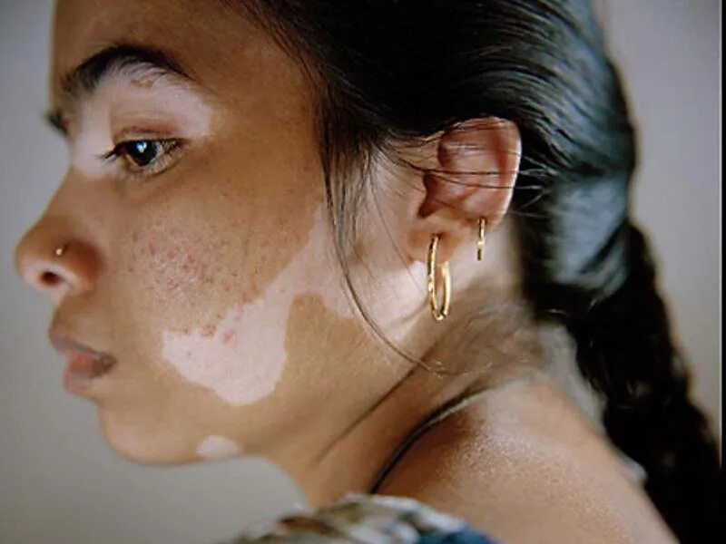 депигментация кожи (витилиго). винни харлоу 2022. пигментные пятна витилиго. витилиго депигментация. витилиго депигментация.