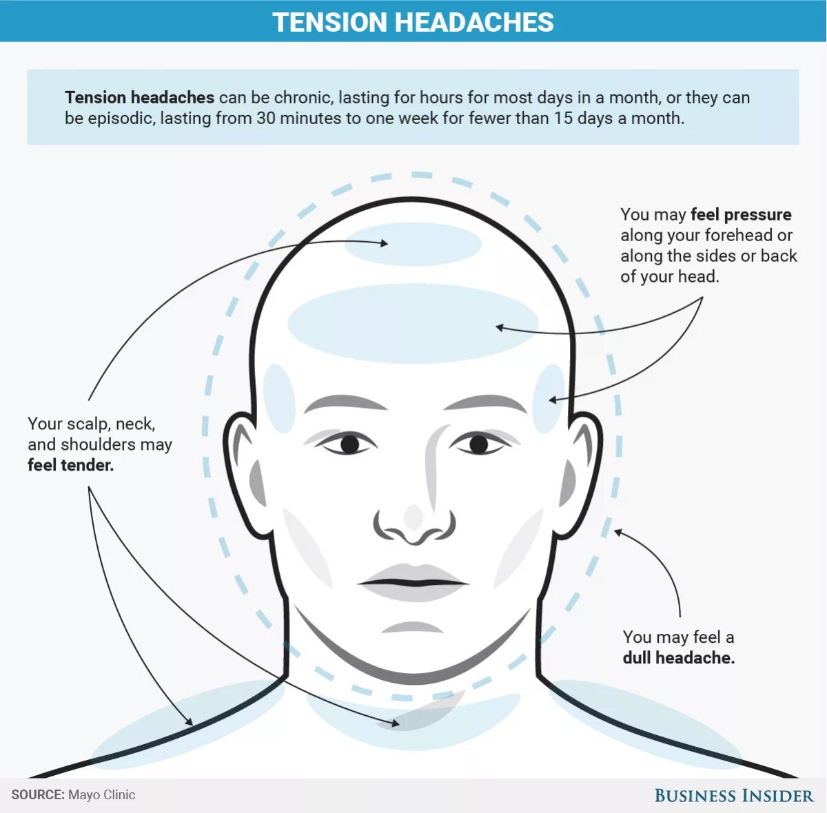Головная боль напряжения (тензионная).. Типы головной боли. Тензионный Тип головной боли. Головная боль схема. Участки головной боли