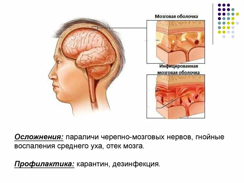 Отек мозговых оболочек. Воспаление оболочек головного мозга. Заболевание воспаление оболочки головного мозга. Отеков мозга головы