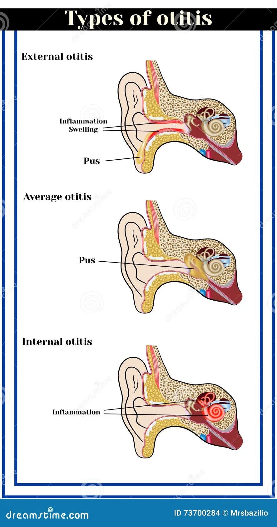 Наружный средний внутренний отит.