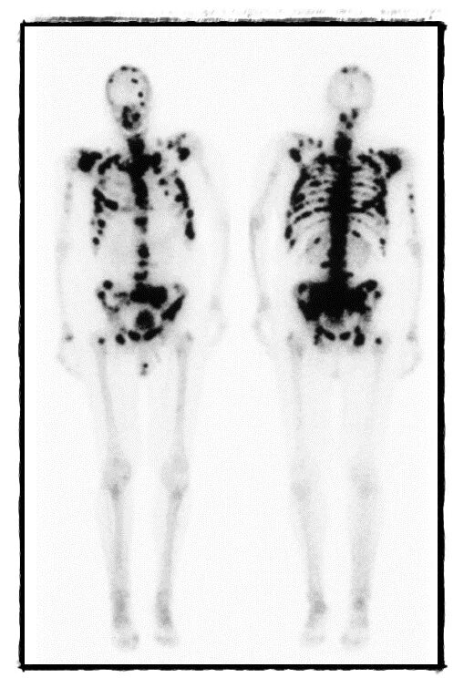 Метастатическое поражение кости. Остеосцинтиграфия метастазы. Сцинтиграфия скелета метастазы. Сцинтиграфия костей метастазы. Сцинтиграфия метастазы в кости.