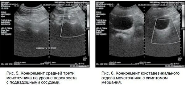 Юкставезикальный отдел мочеточника. Конкремент средней трети мочеточника. Расширенный мочеточник на УЗИ. Расширение верхней трети мочеточника УЗИ. Анализ мочеточника