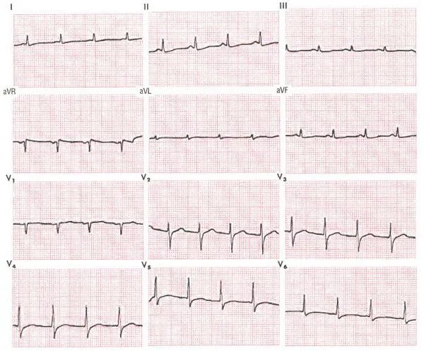 Неспецифический t AVF ЭКГ. Неспецифический зубец т на ЭКГ. Зубец t на ЭКГ. Кардиограмма сердца незначительные изменения St- t. Неспецифические изменения нижней стенки