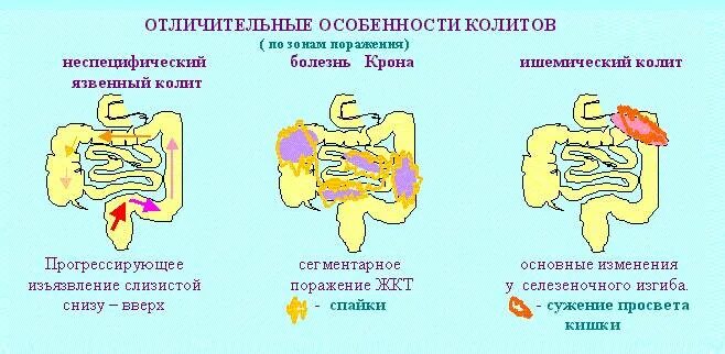 Болезнь крона лечение у взрослых кишечника. Спастический язвенный колит хронический. Неспецифический язвенный колит характерный симптом. Внекишечные симптомы язвенного колита. Хронический спастический колит патогенез.