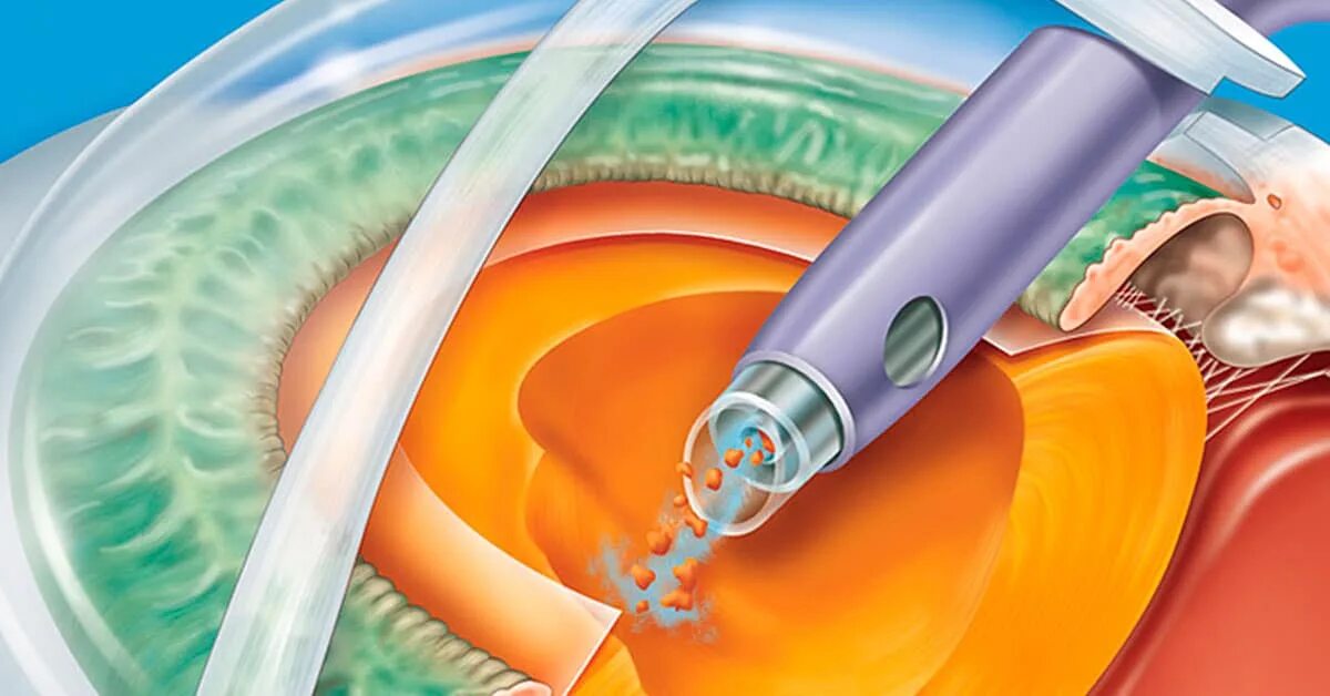 Катаракта восстановление после операции. Катаракта факоэмульсификация. Операция ультразвуковая факоэмульсификация катаракты. Факоэмульсификация катаракты с имплантацией ИОЛ. Ультразвуковая факоэмульсификация катаракты этапы.