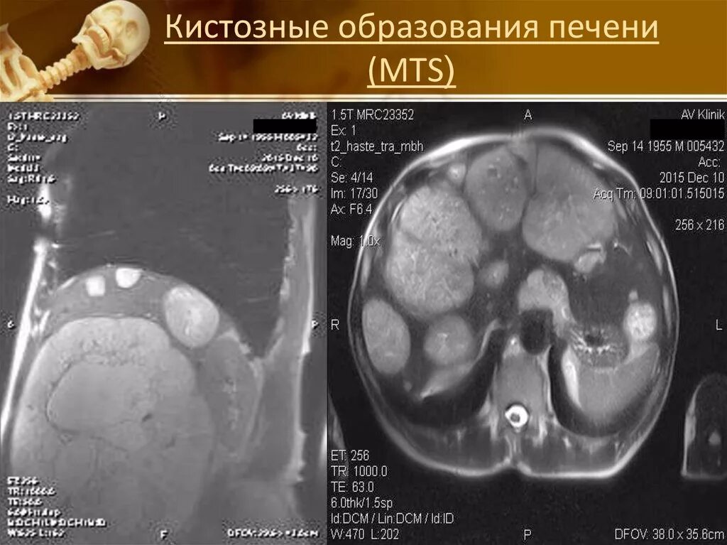 Множественные образования в печени. Множественные объемные образования печени MTS. Объемные образования печени (МТС). Кистозное образование.