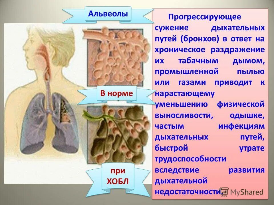 стеноз внегрудных дыхательных путей