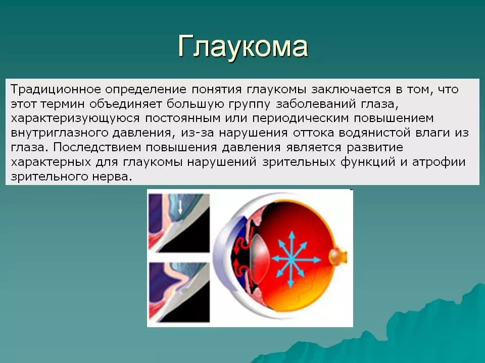 Глаукома форум. Глаукома форум