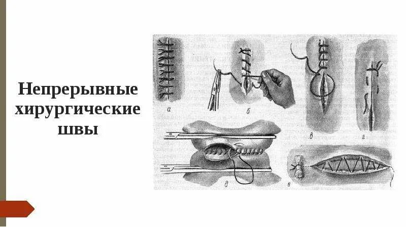 Техника наложения хирургических швов. Реверсивный шов хирургия. Портняжный шов хирургия. Непрерывный хирургический шов. Непрерывный шов в хирургии.