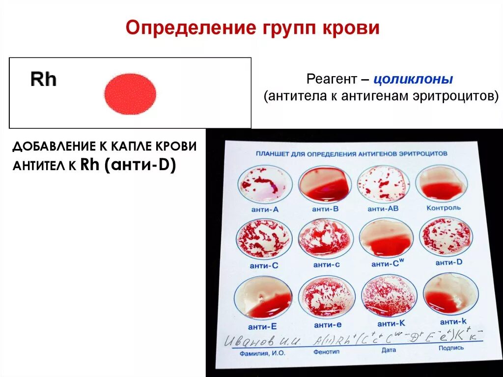 Определение группы крови целиклонами. Определение группы крови и резус фактора цоликлонами таблица. Группа крови по целиклону. Группа крови Цоликлоны. Определение группы крови крови цоликлонами.