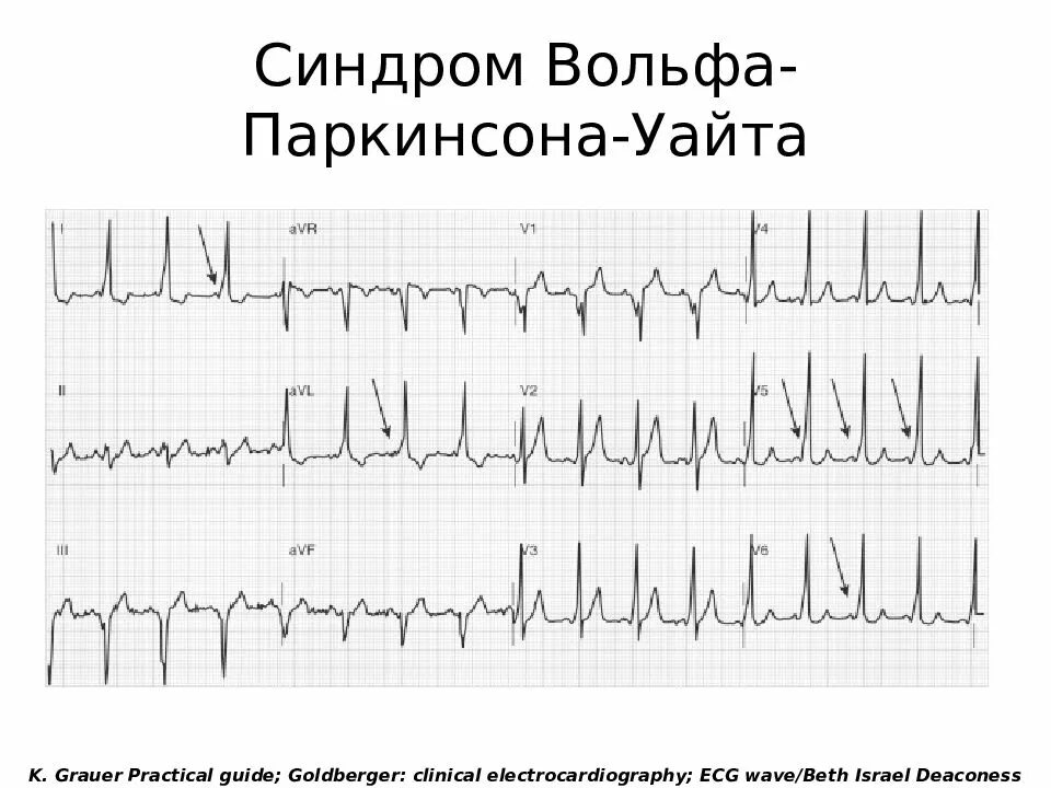 Синдром wpw сердца что это. Экг вольфа паркинсона уайта. Синдром вольфа-паркинсона-уайта на экг. При синдроме вольф-паркинсон-уайта (wpw) на экг наблюдаются. Синдром вольфа-паркинсона-уайта.