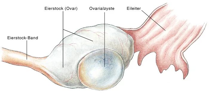 2 в яичниках образуются. Фолликулярная киста яичника клиника. Фолликула киста левого яичника. Цилиоэпителиальная киста яичника. Функционал киста левого яичника.