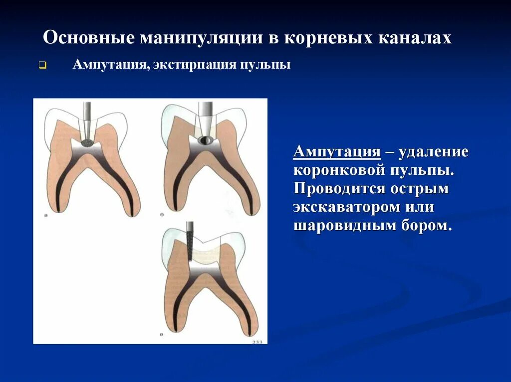 Витальная ампутация пульпы. Пульпотомия ампутация коронковой пульпы временного зуба. Методика девитальной ампутации пульпы. Девитальная пульпотомия. Девитальная ампутация временных зубов.