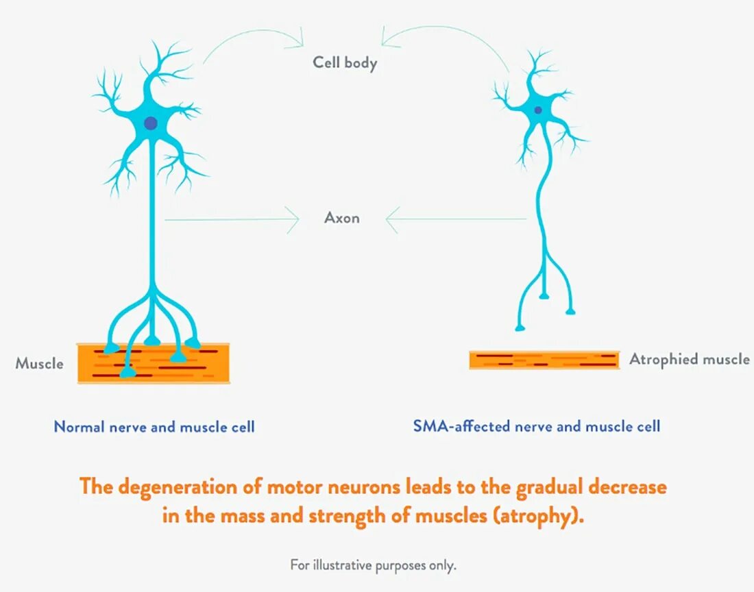 Спинальная мышечная атрофия патогенез. Заболевание двигательных нейронов. Спинальная мышечная атрофия (СМА). Спинальная мышечная атрофия ген.