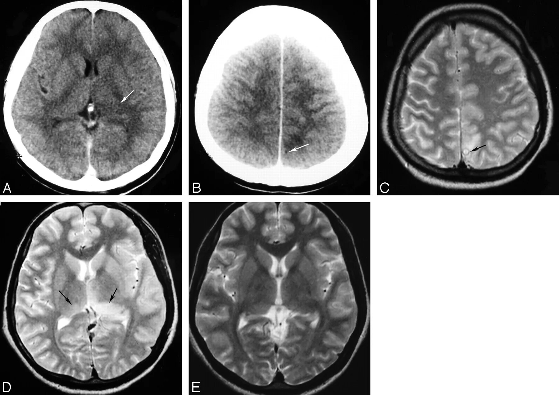 Лейкоэнцефалит. Подострый склерозирующий панэнцефалит мрт. подострый склерозирующий лейкоэнцефалит ван-богарта.