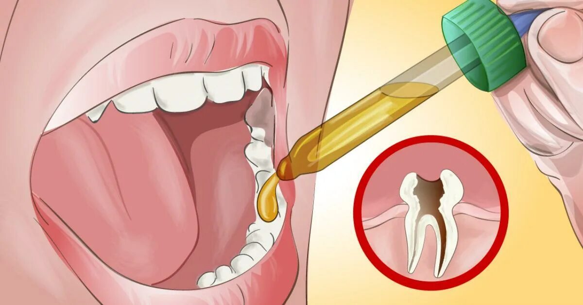 Как отличить зубную боль от воспаления. Избавление от зубной боли. Воспаление полости рта и десен.