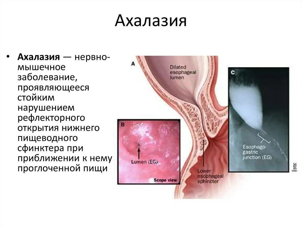 Характерным симптомом ахалазии кардии являются:. Основной клинический симптом ахалазии кардии. Ахалазия кардии пищевода. Ахалазия и кардиоспазм клинические рекомендации.