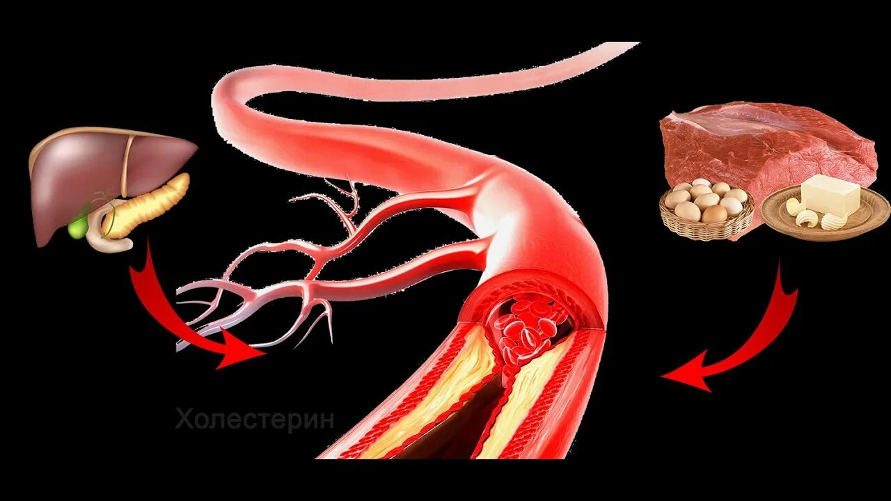 Холестерин в желчном пузыре. Холестерин. Повышен холестерин и желчный пузырь. Что растворяет холестериновые бляшки. Плохой и хороший холестерин.