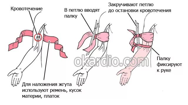 Остановить кровотечение на сонной артерии ответ тест. Наложение жгута при кровотечении из сонной артерии. Остановка кровотечения из сонной артерии алгоритм действий. Артериальное кровотечение фото. Виды кровотечений сонной артерии.