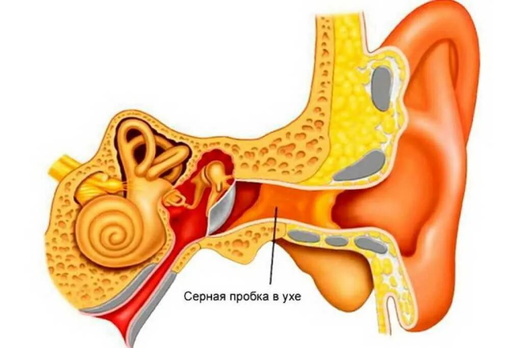 Почему образуются серные. Тубоотит барабанная перепонка. Серная пробка наружного слухового прохода. Наружный отит серная пробка.