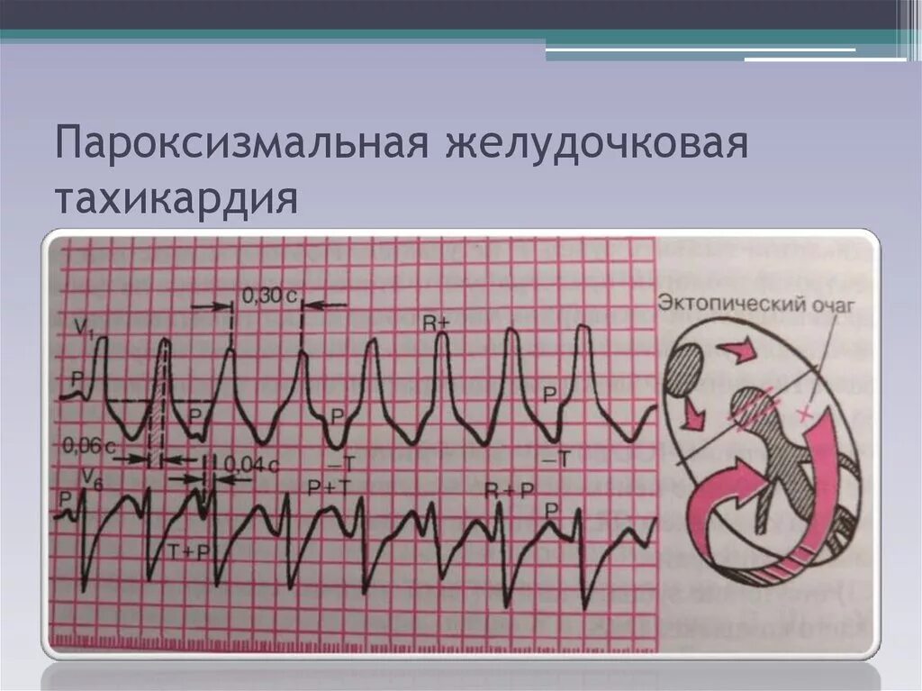 Желудочковая тахикардия на экг. Пароксизмальная желудочковая тахикардия на ЭКГ. Пароксизм ЖТ на ЭКГ. Желудочковая форма пароксизмальной тахикардии.