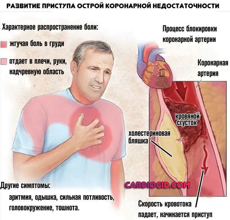 Жжет левой стороны. Острая коронарная недостаточность симптомы. Синдром острой коронарной недостаточности симптомы. Приступ стенокардии.