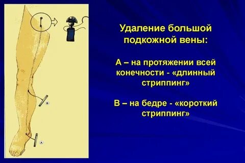 Кроссэктомия большой подкожной