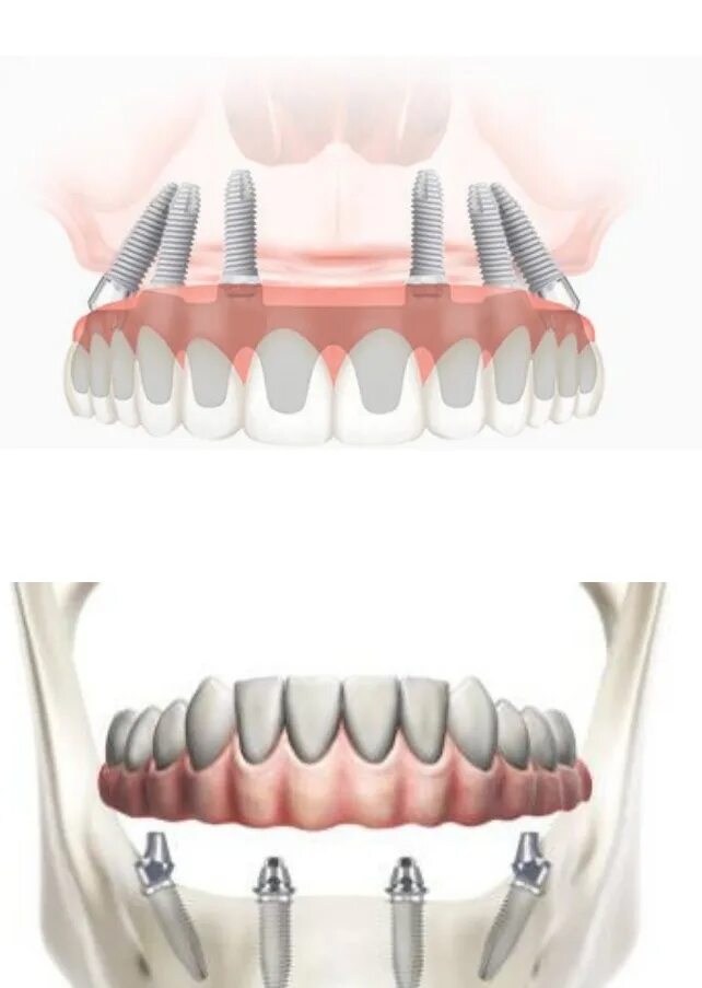 Имплант и мрт можно ли. Дентис имплант. Импланты Impro implantem d4 l-7 all on 6. Имплантата dentis.